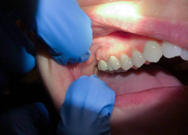 Best Emergency Tooth Extraction in Richland, MO